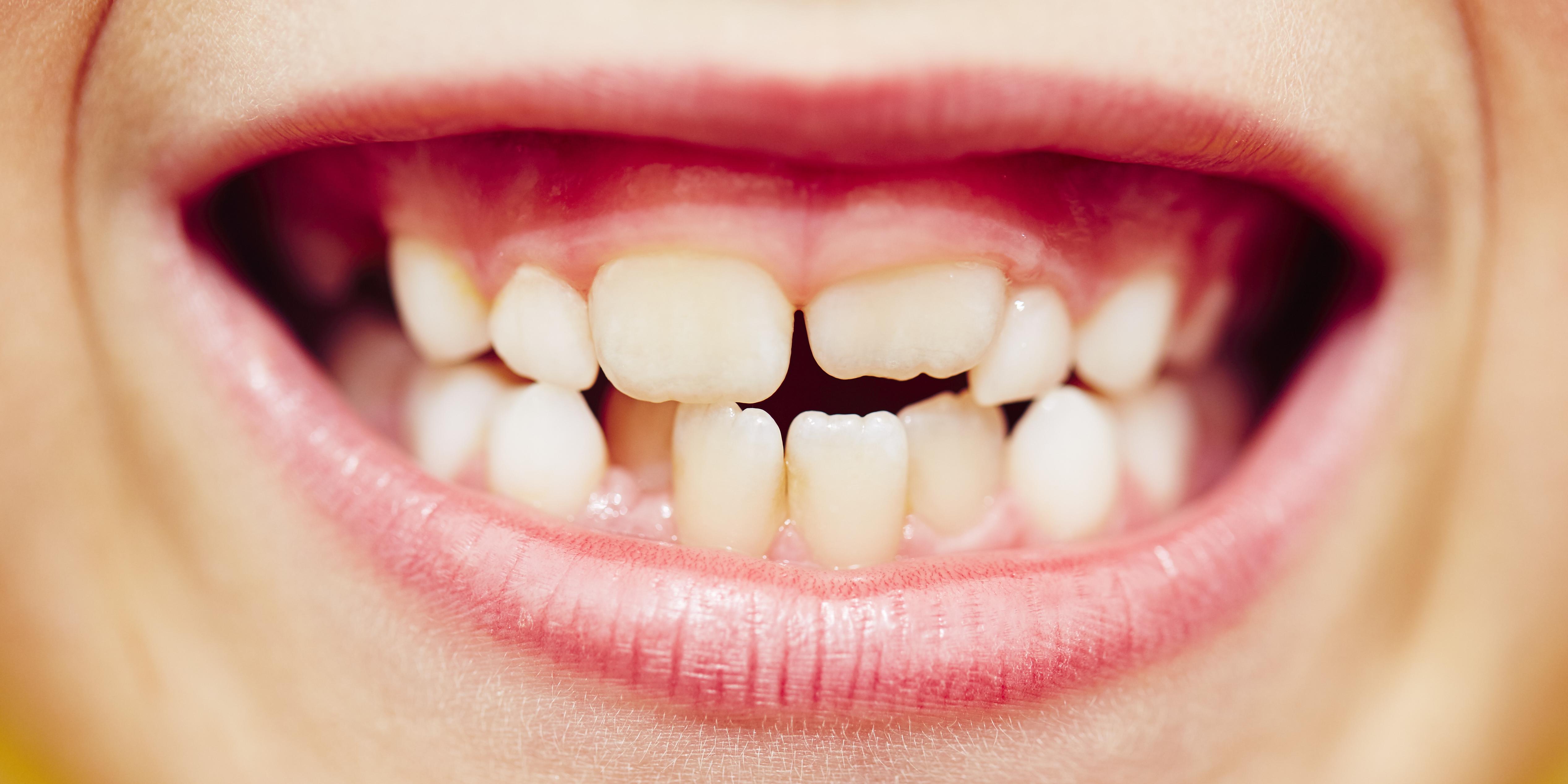 Tandbørstning, mundhygiejne og huller i tænderne 